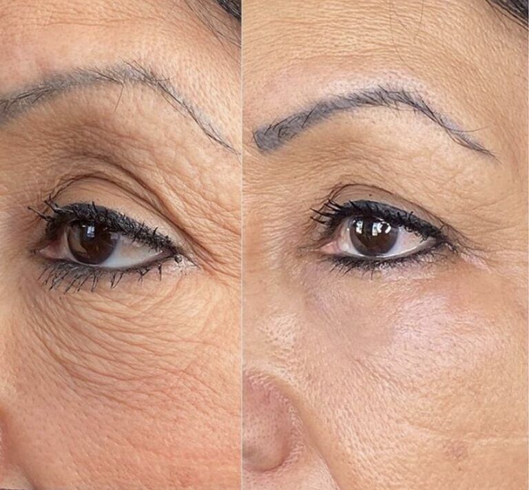 Antes y después de Luisa